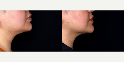 28 year old woman treated with Liposuction, chin Fat Transfer, PrecisionTx - 28 year old female treated with liposuction to the submental neck (double chin) and fat transfer to chin. Photos depict before and 3 weeks after surgery