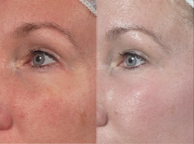 35-44 year old woman treated with Laser Resurfacing - 35-44 year old woman treated with Laser Resurfacing