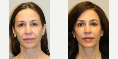Woman treated with Neck Lift - Woman treated with Neck Lift as well as Deep Plane Facelift, Brow Lift, and Lip Lift.Patient didn't liked her jowls and felt that fillers just made her face look full but not refreshed.