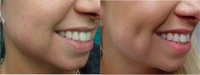 25-34 year old woman treated with Cheek Augmentation - Dimpleplasty adds definition to the facial structure.