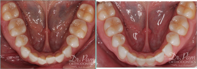 35-44 year old woman treated with Lingual Braces - Lingual braces placed to line up bottom front teeth.