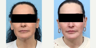 55-64 year old woman treated with Deep Plane Facelift, Facial Fat Transfer, CO2 Laser, Lip Lift - Dr. Wise performed a deep plane facelift, lip lift, fat transfer and CO2 laser to rejuvenate her appearance, enhance facial features, and reduce the visible effects of aging,  sagging skin, and loss of volume. These procedures restored a youthful, more vibrant look.