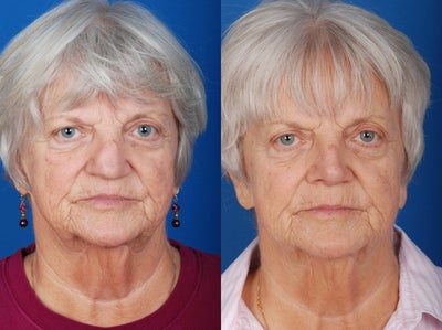 Revision Rhinoplasty -
The patient is a 70 year old female who presented for revision rhinoplasty approximately 2 years after her primary surgery. The patient presented a early photograph of herself to assist in aesthetic and functional restoration.
