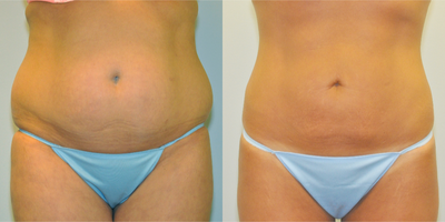 38 year old woman treated with Liposuction - 38 year old female treated with SafeLipo of abdomen and flanks.