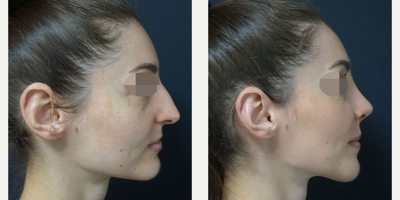 25-34 year old woman treated with Chin Surgery - Rhinoplasty - Chin Surgery - Rhinoplasty surgery performed by Ozge Ergun, MD - 8 Months Post Operative