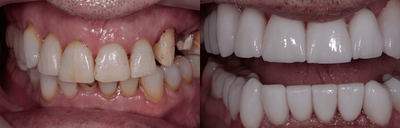 25-34 year old man treated with Dental Bonding - Bridge placed to help patient with partially missing tooth and gaps/irregular spacing.