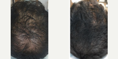 35-44 year old man treated with Mesotherapy - Early intervention is essential for male type hair loss (androgenetic alopecia). We benefit from mesotherapy and PRP which reduce hair loss and thicken the hair, thus giving it a more strong appearance. It should not be forgotten that the effects of the treatments will begin to be seen after 3 months. If you continue maintenance therapy regularly, success rate will surely increase