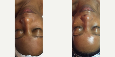 Woman treated with Dermaplaning - Woman treated with Dermaplaning