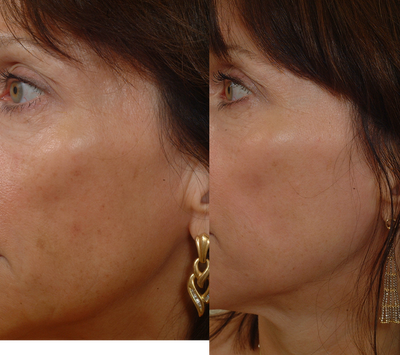 Pearl Laser Treatment - 
	Pearl laser-one treatment
