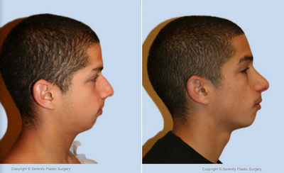 Rhinoplasty - Rhinoplasty