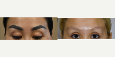 Los Angeles Eyebrow Makeup Removal - Los Angeles patient came to our office for permanent makeup removal at the eyebrows.  Very, very dark brows and after 5 visits, brow coloration is almost completely gone.  Treatments done with the Palomar Q Yag 5 and Medlite C6 Nd:Yg q-switched lasers.  Treatments done approximately 2 months apart.  2% Lidocaine injections used for numbing.  Patient wanted to pencil her eyebrows subsequent to this treatment and has very little hair before and after treatment.