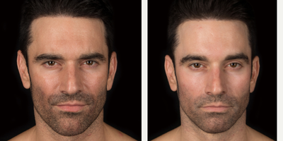 35-44 year old man treated with Cosmelan - Cosmelan Treatment for Sun Damage