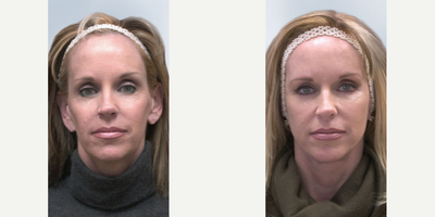 63 year old woman treated with Sculptra Aesthetic - 63 year old woman treated with 6 vials of Sculptra Aesthetic, shown 9 month post op.