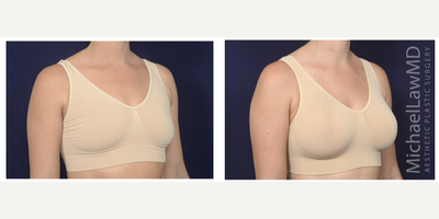 25-34 year old woman treated with Natrelle Breast Implants - Breast augmentation. Follow-up photo taken 1 month after the procedure.
