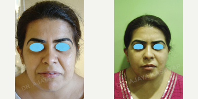 25-34 year old woman treated with Jaw Reduction, MACS Facelift - 33 year old who underwent jaw reduction and MACS face lift
