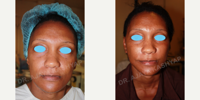 45-54 year old woman treated with MACS Facelift - 49 year old who underwent MACS facelift