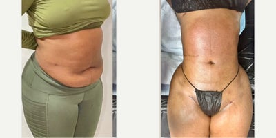 25-34 year old woman treated with Liposuction, Brazilian Butt Lift, BodyTite - 25-34 year old woman treated with Liposuction, Brazilian Butt Lift, BodyTite
