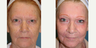65-74 year old woman treated with Dermabrasion - Deep chemical peel with phenol (Hetter peel) combined with dermabrasion on the full face.  No additional surgery performed
