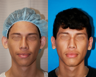 20 year old man treated with Ear Surgery - This male patient aged 20 was treated with an otoplasty (aka ear surgery). The after photo was taken 17 days post-surgery.