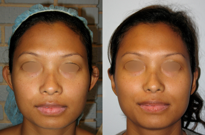 30 year old woman treated with Ear Surgery (aka Otoplasty) - This female patient aged 30 was treated with an ear surgery (aka otoplasty.) The after photo was taken 2 years and 10 months post-surgery.
