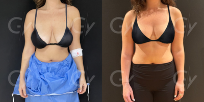 35-44 year old woman treated with Breast Lift, Breast Reduction - 35-44 year old woman treated with Breast Lift, Breast Reduction by M.D. Gray Yeiladal