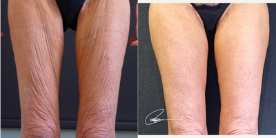 65-74 year old woman treated with Skin Tightening - This patient underwent Macroneedling (Collagen Induction Therapy)