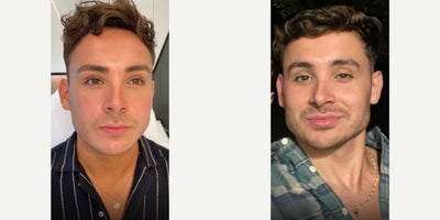 18-24 year old man treated with Chin Filler, Lip Fillers - Our patient today is back with us for another treatment, as he loved his previous results so much. He knows we are the best so he flies from out of state to see us. In the past, we have used filler for his lips- but today we are venturing to his jawline and chin as well. He already had great features, so we just enhanced them making his jawline more chiseled, chin more square, and adding a touch of volume to his lips to complete the look. Immediately after treatment he was slightly swollen but that diminished after a couple of days.