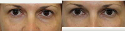 Restylane with cannula for under-eye bags - Restylane was placed with cannula to under-eye hollows and upper cheek to reduce the appearance of under-eye bags and dark circles.