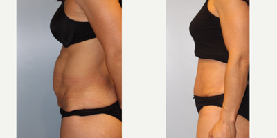 25-34 year old woman treated with Tummy Tuck - Tummy tuck