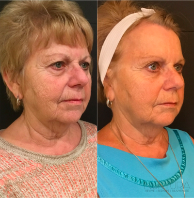 The Nu Face Procedure -- All Natural Fat Transfer, exclusively at Nurtura - As we get older and lose collagen, or experience weight loss, volume in the skin is depleted and the structural integrity of the skin's tissue is compromised. The Nu Skin Rejuvenation Procedure utilizes your own regenerative cells and fat tissue to replace volume loss in the face and body. Exclusively at Nurtura, the Nu Procedure is a revolutionary way to naturally reverse the signs of aging with minimal to no downtime