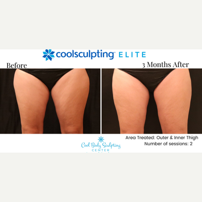 25-34 year old woman treated with CoolSculpting Elite - CoolSculpting results at Cool Body Sculpting Center