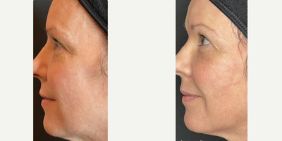 45-54 year old woman treated with Opus Plasma - This client wanted to address her fine lines and wanted to stimulate collagen to help decrease the signs of aging. This is 3 weeks after her second Opus treatment!