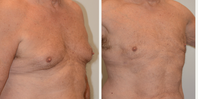 65-74 year old man treated with Breast Reduction - 74 Year old male patient treated for Gynecomastia