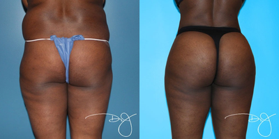 Butt Augmentation - This patient had liposuction and contouring of upper and lower abdomen, lower back, flanks and inner thighs with Fat transfer to buttock