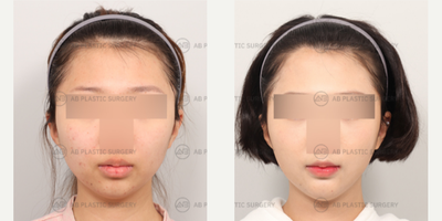 25-34 year old woman treated with Genioplasty, V Line Surgery, Rhinoplasty, Asian Rhinoplasty - V-Line Surgery, GenioplastyRhinoplasty (Nose Ridge+Nose Tip+Hump Correction+Osteotomy)