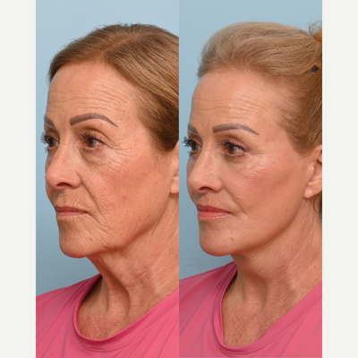 65-74 year old woman treated with Deep Plane Facelift, Neck Lift, Brow Lift, Double Eyelid Surgery, Lip Lift, Facial Fat Transfe - How is she in her 70s?! Absolutely stunning