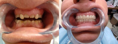 55 yr old male smile makeover - patient had severly worn down teeth. his dsire was for not only a better appearance but better chewing function. We used Snap-on Smile to restore his appearance and function and will eventually restore on a fixed basis using porcelain crowns and jackets.