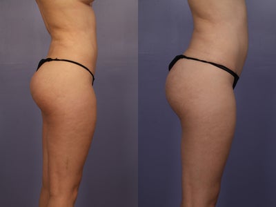 Revision Brazilian Butt Lift - Early 20s female, underwent liposuction and fat transfer to buttocks (Brazilian butt lift) by another surgeon previously. Patient came to me for a revision because she noted significant contour irregularities to the love handle area from the previous liposuction and an asymmetry of the buttocks with more upper fullness of on her left buttocks than on her right. I performed liposuction to her arms, back, love handles, inner thighs and fat transfer to right buttocks for symmetry.