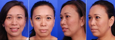 Mole Removal Left Side of Nose - 36 year old woman who requested the removal of a mole from the left side of her nose.  After photos are shown from 2 months after surgery.