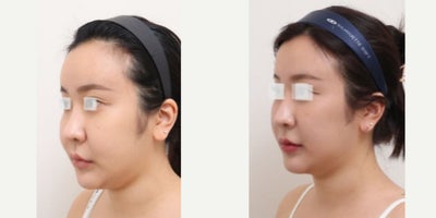 25-34 year old woman treated with AccuLift, Laser Liposuction, Liposuction - 28 Years old female patient Chief Complain: - over injected forehead (fat graft 3 years ago in X clinic) - double chin & overall facial fat Treatment Plan: full face liposuction /forehead reconstruction by liposuctionOutcome: - forehead liposuction pure fat: 20cc- double chin liposuction pure fat: 50- face liposuction pure fat : 124cc (cheek side, front, near ears, zygomatical angle)
