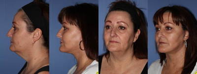 56 year old female, Neck Lift to improve neck and jaw line - This is a 56 year old female that came to see us because she was unhappy with her neck, her jowls, the overall loss of volume to her face and her overall aged appearance. She had a face lift with fat grafting. The fat grafting added volume to her nasal labial folds, cheeks, lips and marionette lines.
