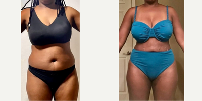 25-34 year old woman treated with Liposuction, BodyTite - 25-34 year old woman treated with Liposuction, BodyTite