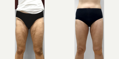 45-54 year old woman treated with Morpheus8 - Patient wanted to lessen the look of crepe-y skin on her legs.