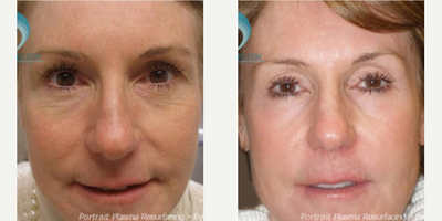 55-64 year old woman treated with Fraxel Repair - Before and after Portrait Plasma Resurfacing
