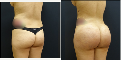 25-34 year old woman treated with Power-Assisted Liposuction (PAL) - She underwent a Brazilian Butt Lift (fat transfer to the butt and hips). She had liposculpting of her abdomen, back and flanks. Then had fat transfer to her buttock and hips. The combination of the liposculpting and fat transfer gives her an incredible hourglass figure.