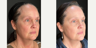 45-54 year old woman treated with Opus Plasma, Skin Tightening, Skin Rejuvenation - This is 2 weeks after having 1 Opus Plasma treatment.