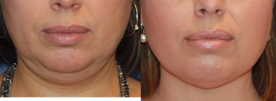 35-44 year old woman treated with CoolMini - CoolMini procedure done, 2 treatments 1 month apart
