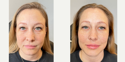 25-34 year old woman treated with Lip Fillers, Cheek Fillers, Juvederm, Dermal Fillers, Vollure, Voluma - 1cc of Vollure XC to the lips0.5cc of Voluma XC to each cheek
