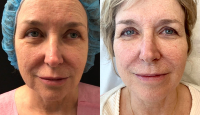 25-34 year old woman treated with Restylane Silk - Liquid facelift - 25-34 year old woman treated with Restylane Silk