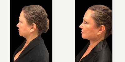 55-64 year old woman treated with Chin Liposuction, FaceTite - 56 y.o female who was concerned with double chin chin appearance, neck laxity and poorly defined jawline underwent chin and neck liposculpting and facetite under local anesthesia . At 2 months post-op, her double chin is gone and her jawline and neck laxity is significantly improved.